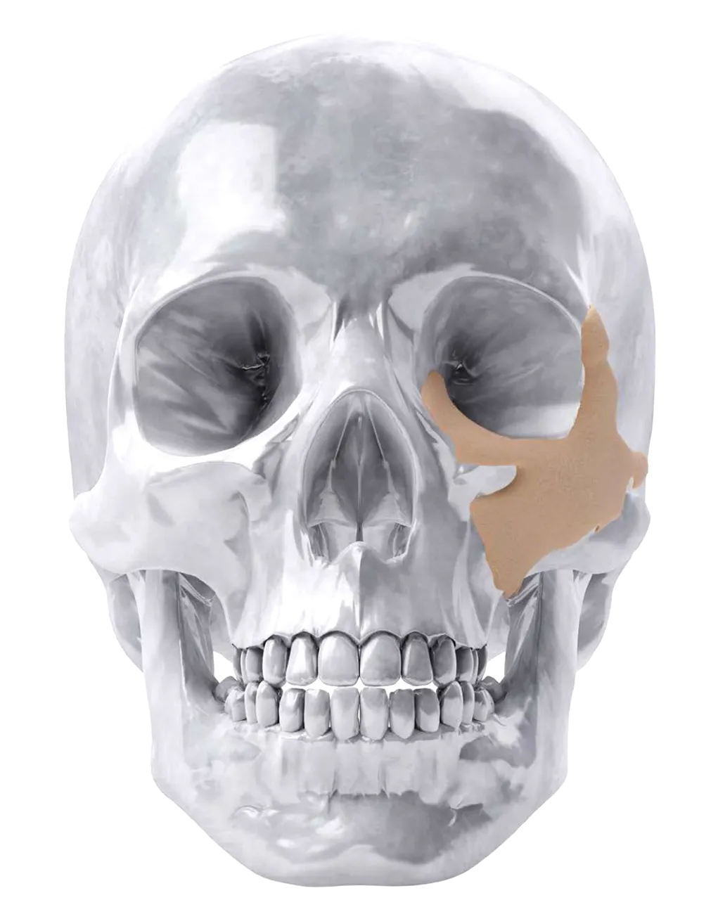 lustración de implantes personalizados htr-pekk marca zimmer biomet colocados