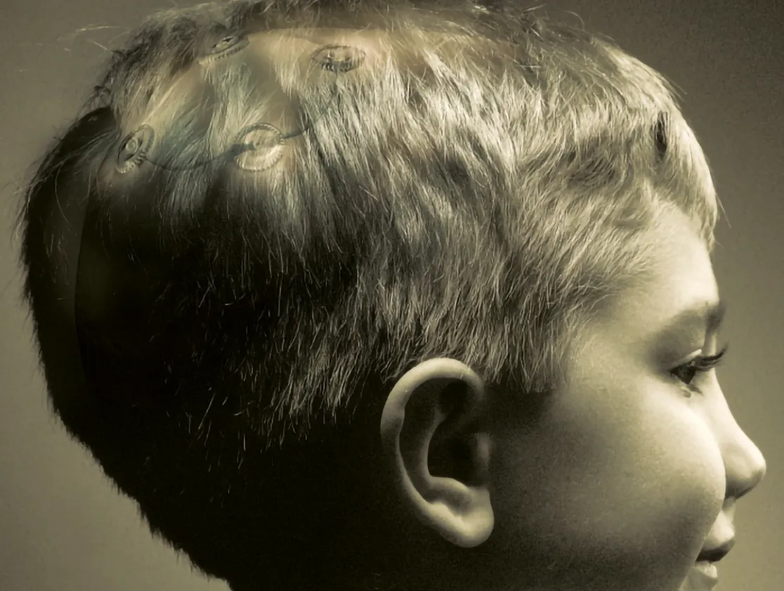 lustración de implantes rapidflap marca zimmer biomet colocados